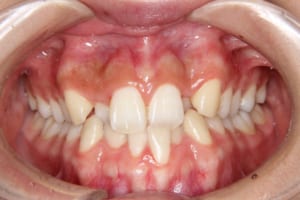 上の側切歯が口蓋側転位しています